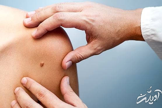 شخصیت شناسی خال روی شانه خال روی شانه